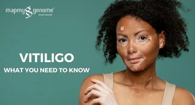 Vitiligo: What You Need to Know - Mapmygenome